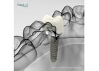 Top Trusted Dental Implant Manufacturers in Paraguay | 2025
