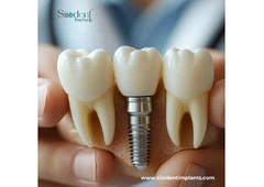 Top Rated Dental Implant Suppliers in Mexico to Trust