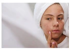 Say Goodbye to Acne Scars – Effective Acne Scar Treatment in Kolkata at Image Clinic