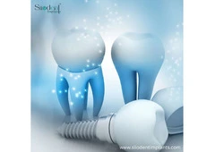 Recognized The Best Dental Implants Brands in Peru
