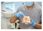 Dental implants Tijuana offers natural-looking and durable teeth replacements 
