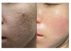 Best Acne Scar Treatment in Lambeth