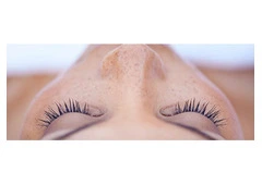 Laser treatment for face pigmentation