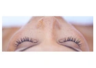 Laser treatment for face pigmentation 
