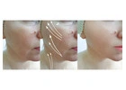 Botox Treatment in Kolkata – Smooth, Youthful & Natural Results
