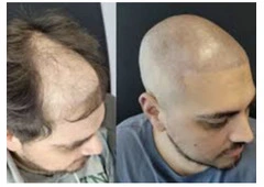 Best Scalp Micropigmentation in Richmond Hill