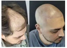 Best Scalp Micropigmentation in Richmond Hill