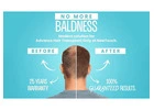 Restore Your Hair and Confidence with New Touch Hair Transplant Clinic Ahmedabad