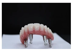 Full Mouth Dental Implants in Mexico with Teeth Savers