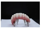 Full Mouth Dental Implants in Mexico with Teeth Savers