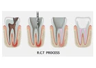 Save Your Tooth – Advanced Root Canal Treatment in Noida
