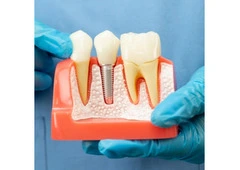 Dental Implant Solutions in Chembur, Mumbai