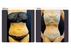 Tummy Tuck Surgery in Delhi - Dr Rajat Gupta