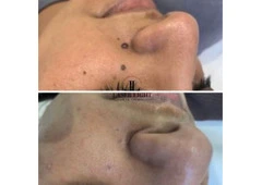 Skin tag removal clinic Goodmayes