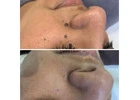 Skin tag removal clinic Goodmayes 