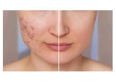 Best Acne Treatment in Steeles