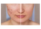 Best Acne Treatment in Steeles
