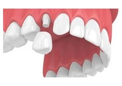 Quick Smile Restoration