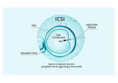 ICSI Packages in Delhi: What’s Included and How to Secure the Best Deal