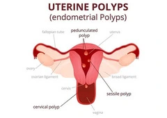 Hysteroscopy Procedure cost in Delhi - Dr Rhythm Gupta