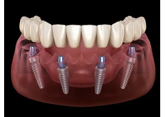 All-on-4 Dental Implants in Tijuana, Mexico – Affordable, Life-Changing Results!