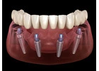 All-on-4 Dental Implants in Tijuana, Mexico – Affordable, Life-Changing Results!