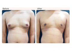Gynecomastia Surgery Cost in Delhi - Dr Rajat Gupta
