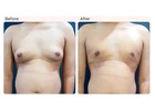 Gynecomastia Surgery Cost in Delhi - Dr Rajat Gupta