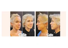 Schedule Facelift Surgery Consultation with Certified Surgeons