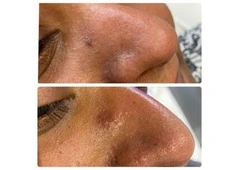 Laser removal of skin tag