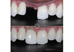 Understanding Safe and Timely Tooth Extraction Options