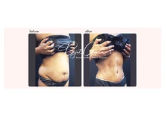Latest Tummy Tuck Surgery Techniques Available Today