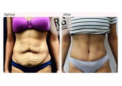 Tummy Tuck Surgery in Delhi -Dr Rajat Gupta