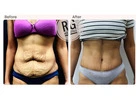Tummy Tuck Surgery in Delhi -Dr Rajat Gupta