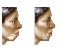 Chin augmentation surgery cost in Delhi - Dr Rajat Gupta