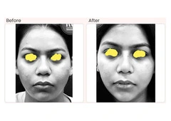 Buccal Pad Fat Removal Cost In Delhi - Dr Rajat Gupta