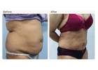 Liposuction Surgery Cost in Delhi - Dr Rajat Gupta