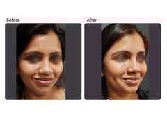 Dimple Creation Surgery Cost in Delhi - Dr Rajat Gupta