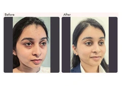 Eyelid surgery in Delhi - Dr Rajat Gupta