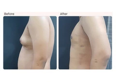 Gynecomastia Surgery in Delhi - Dr Rajat Gupta