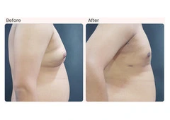 Gynecomastia Surgery in Delhi - Dr Rajat Gupta