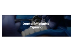Dental implants Tijuana offers natural-looking and durable teeth replacements