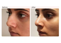 Rhinoplasty Surgery in Delhi - Dr Rajat Gupta