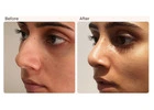 Rhinoplasty Surgery in Delhi - Dr Rajat Gupta