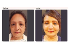 Eyelid Surgery in Delhi - Dr Rajat Gupta