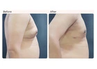 Gynecomastia Surgery Cost in Delhi - Dr Rajat Gupta