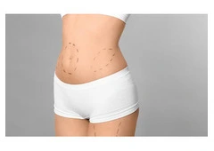 What Is the Cost of Liposuction Surgery?