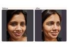 Dimple Creation Surgery Cost in Delhi - Dr Rajat Gupta