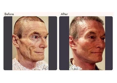 Facelift Surgery Cost In Delhi NCR - Dr Rajat Gupta