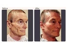 Facelift Surgery Cost In Delhi NCR - Dr Rajat Gupta